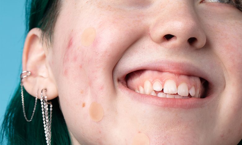 acne dots