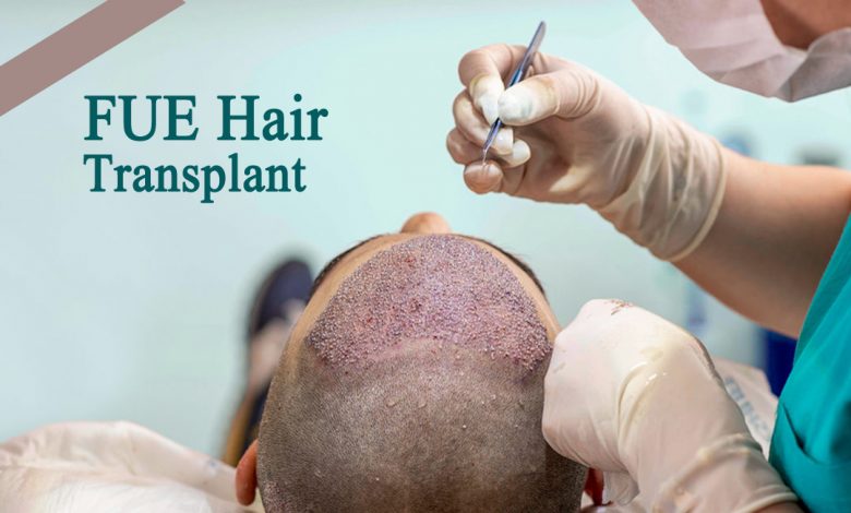 fue hair transplant- Some Instructions you should follow after FUE Hair Transplant