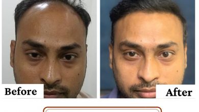 Photo of 5 Secrets You Must Opt Before Hair Transplant Surgery