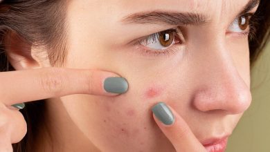 Photo of Best way for Acne Treatment and Scare Removal