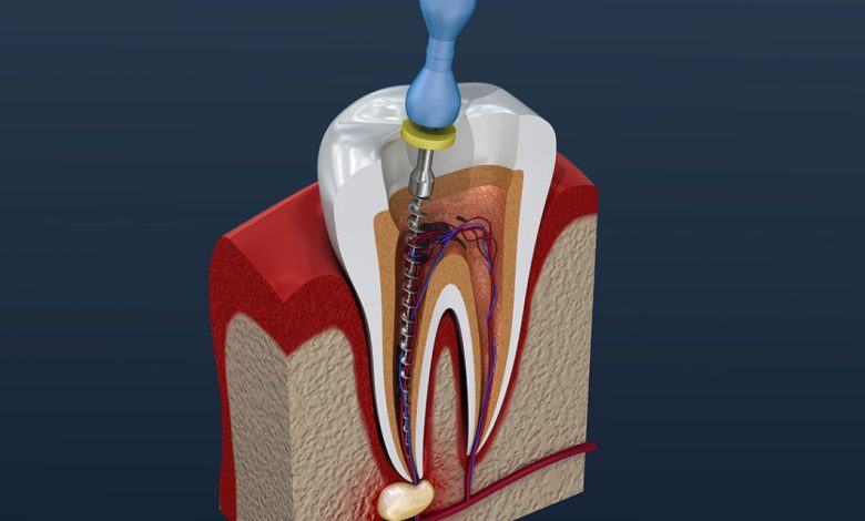 root canal recovery time