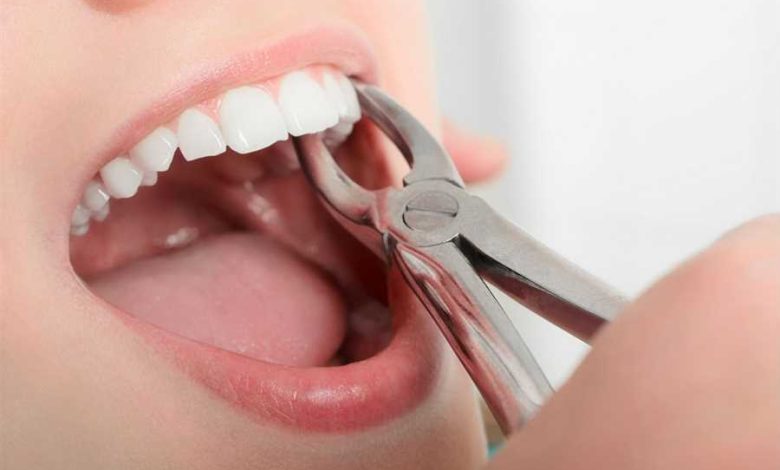 tooth extraction near me