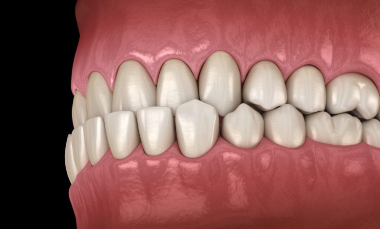 Fix Underbite