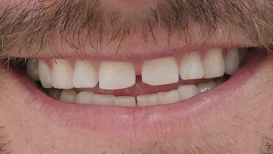 Photo of Are You Worried About Teeth Gap Filling?