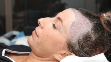 Photo of Female Hair Transplant: Procedure, Recovery, Complications And More