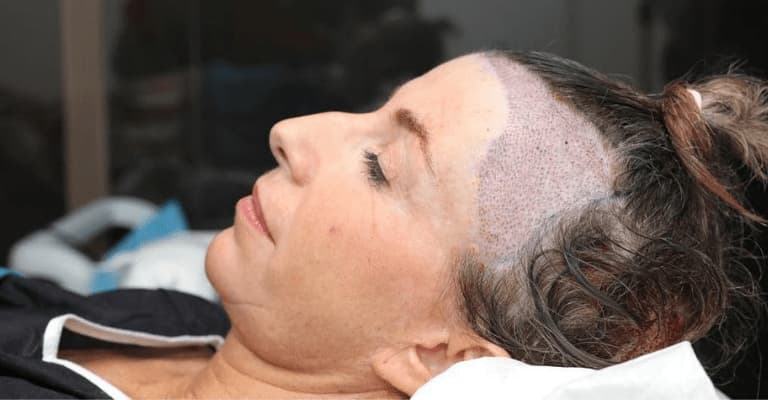 Female Hair Transplant in Dubai