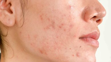 Photo of Everything you need to know about Acne Scars