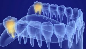 Wisdom Teeth Extraction In Perth: A Beginners Guide